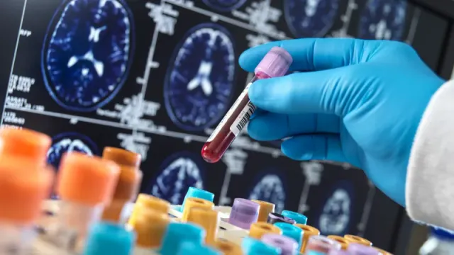 Revolucionário Teste de Sangue com IA Promete Diagnóstico Preciso de Demências M